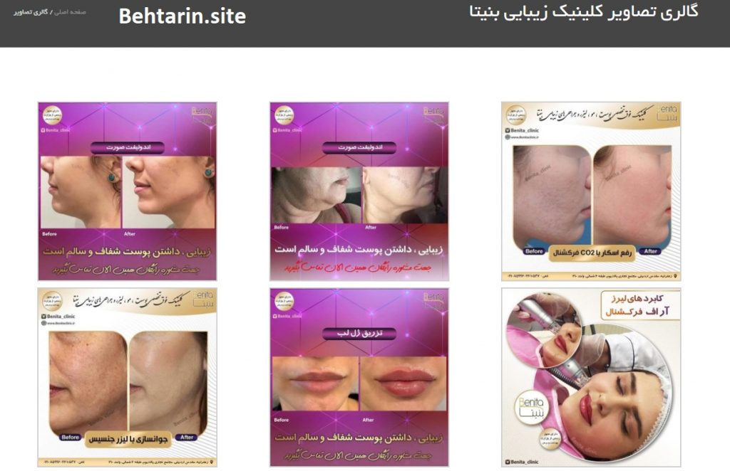 بنیتا-گالری تصاویر