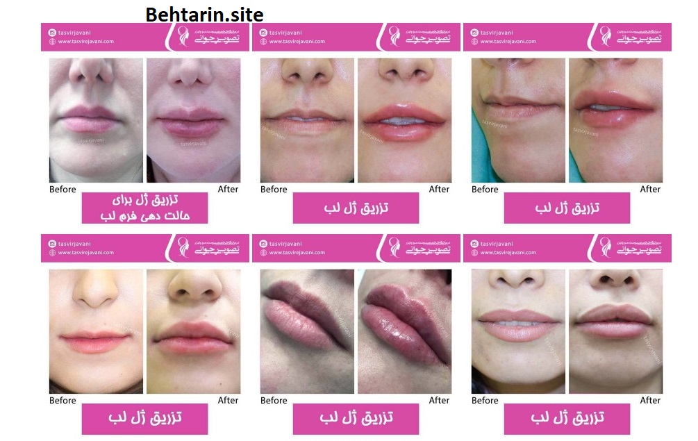 تصویر جوانی-تزریق ژل به لب